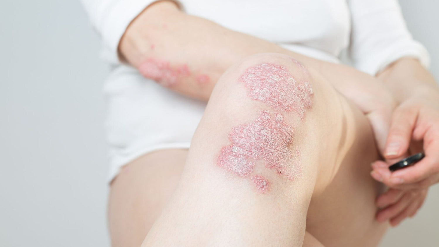 Wat is psoriasis en hoe kun je opflakkeringen verminderen?